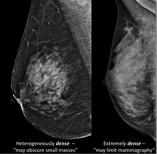 Having a mammogram – Three Counties Breast Clinic